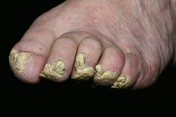 Psoriasi dell'unghia del piede