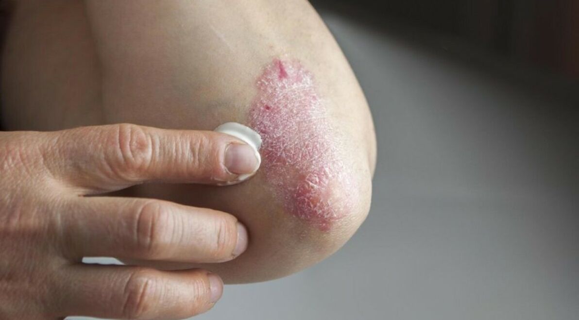 Psoriasi, che colpisce la pelle e il cui trattamento prevede l'uso di unguenti