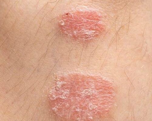 Aspetto delle placche di psoriasi