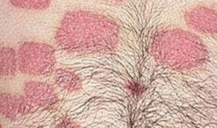 Diverse formazioni rosa sullo stomaco
