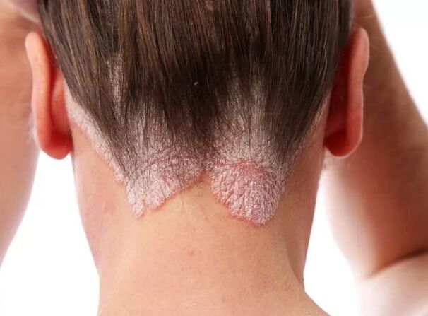 Eritroderma psoriatica