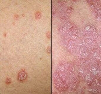 Placche di psoriasi