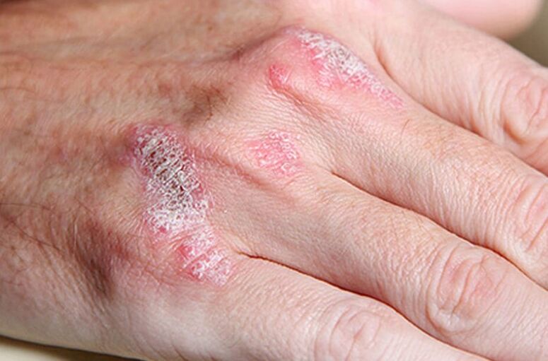 Bisogni ladomarly della psoriasi