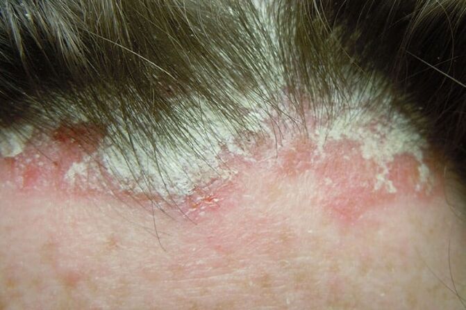 La psoriasi cattura l'intera parte pelosa della testa