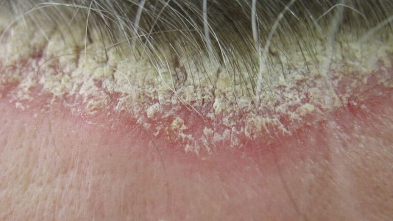 Psoriasi del cuoio capelluto