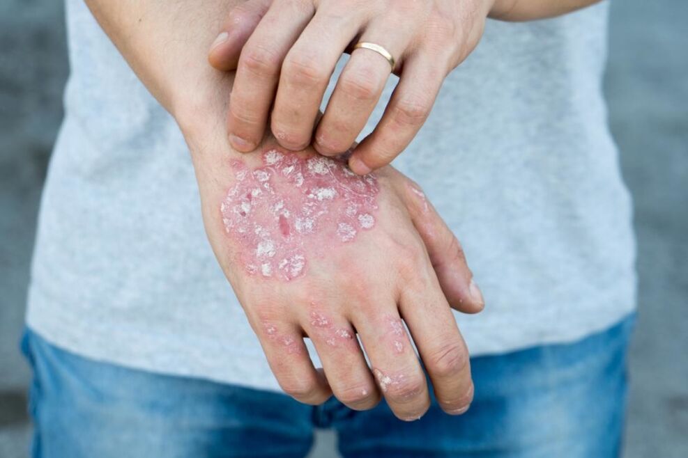 La psoriasi è