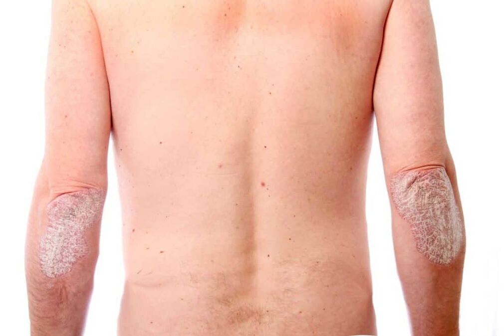 La seconda fase della psoriasi