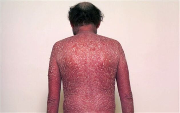 La terza fase della psoriasi