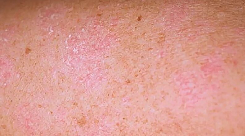 Lo stadio regressivo della psoriasi