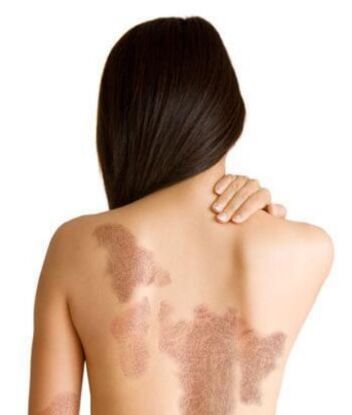 Fase della psoriasi a seconda dell'area della lesione