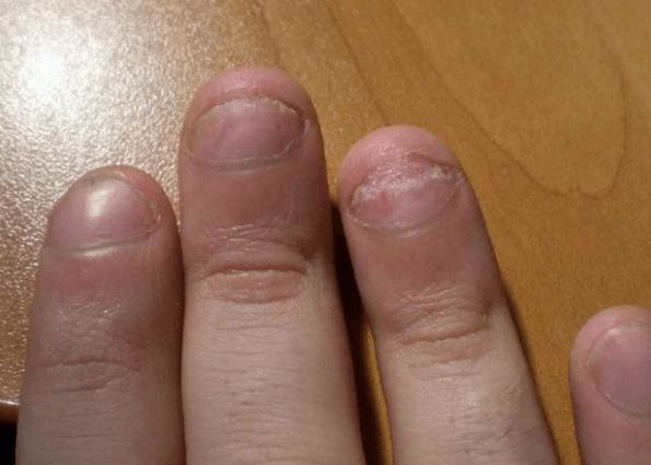 Psoriasi delle unghie