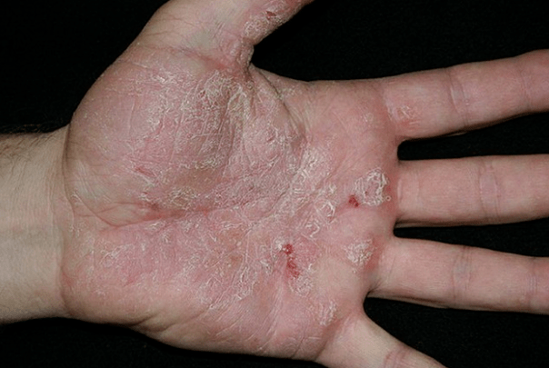 Psoriasi nelle mani