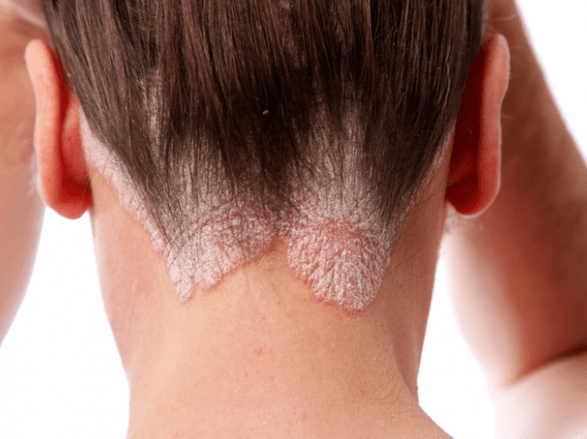 Psoriasi sulla testa