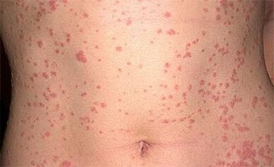 Psoriasi sul corpo