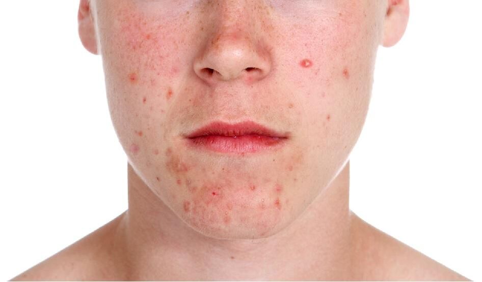 Psoriasi sul viso