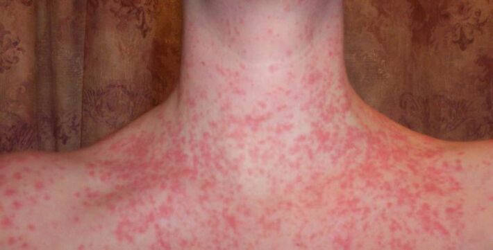 Psoriasi sul corpo