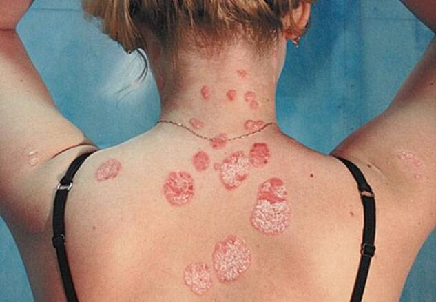 Psoriasi sul retro