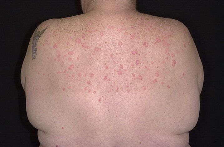 Psoriasi sulle spalle