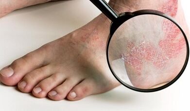 Modi per trattare la psoriasi