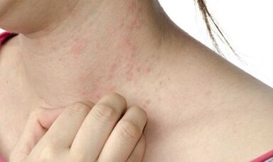 Trattamento della psoriasi avanzata
