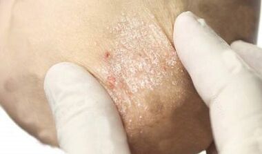 Trattamento della psoriasi in fase di attenuazione