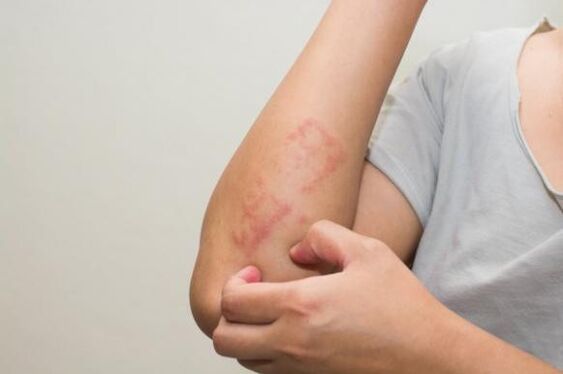 Gli ultimi metodi per il trattamento della psoriasi