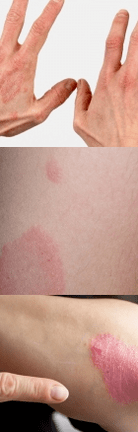 Psoriasi della fase iniziale nelle mani
