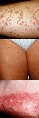 Psoriasi sui piedi