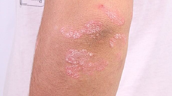 Foto della psoriasi in fase iniziale