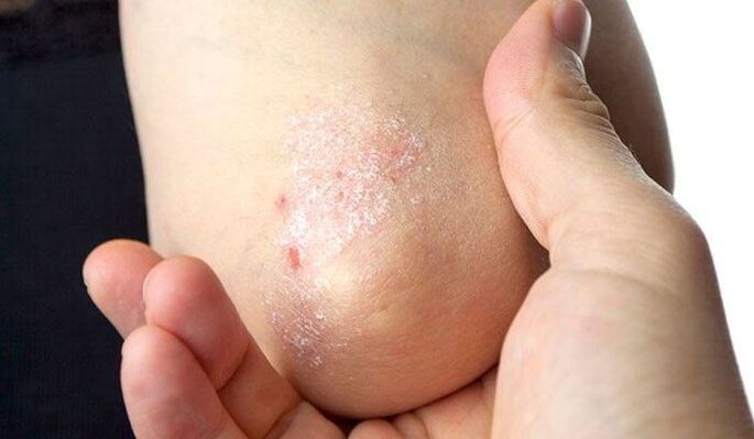 I sintomi della psoriasi nelle fasi iniziali