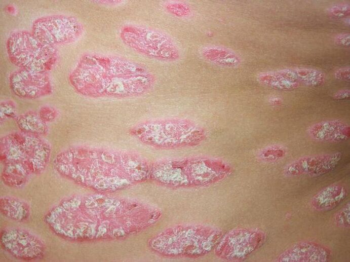 Psoriasi a placche