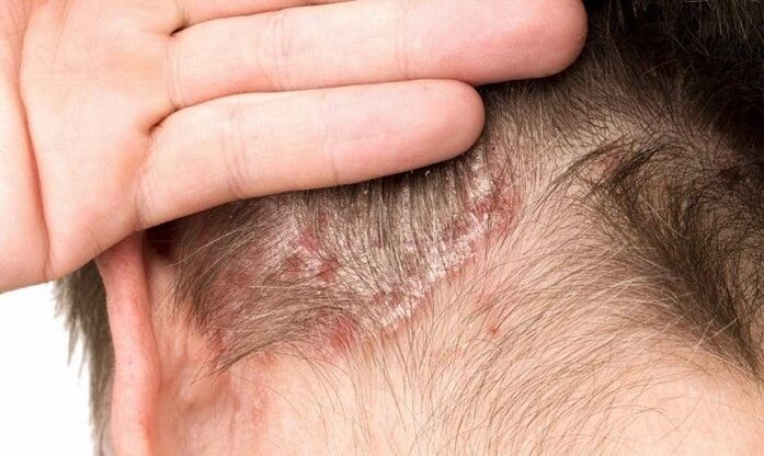 Psoriasi sulla testa