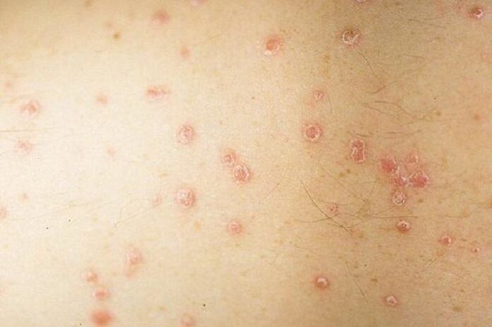 Sintomi della psoriasi a chiazze