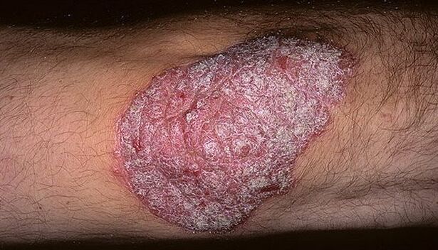 psoriasi