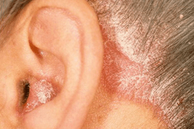 Cause della psoriasi