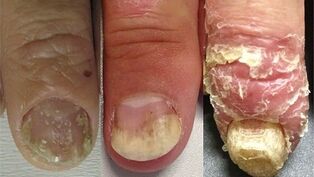 Stadi di sviluppo della psoriasi delle unghie